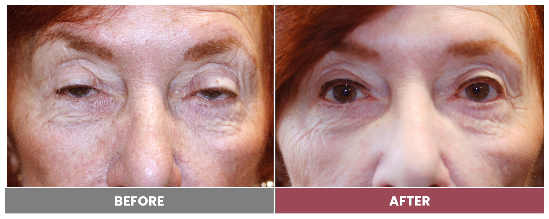 PTOSIS REPAIR - Case 23